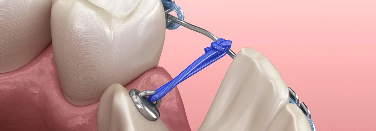 ortodoncia canino inluido